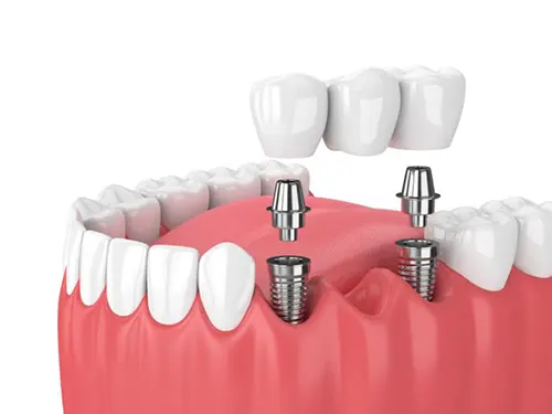 Multiple dental implants